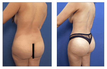 Buttock Augmentation Surgery Abu Dhabi
